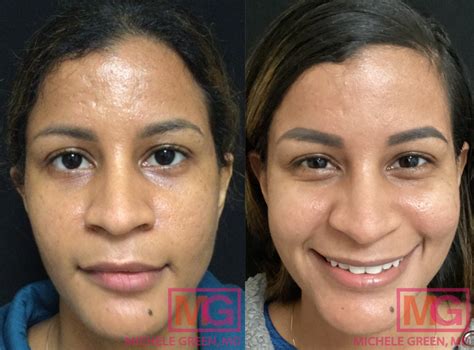 chin acne scars