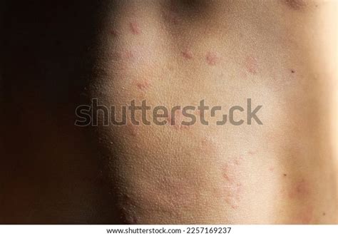 Food Allergy Boy Red Spots Child Stock Photo 2257169237 | Shutterstock