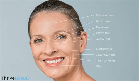 Face Botox Map at Leann Weaver blog