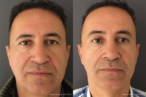 Blepharoplasty Before & After Gallery: Patient 11