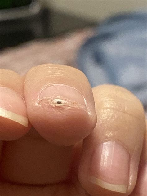 Dark spot under fingernail : r/DiagnoseMe