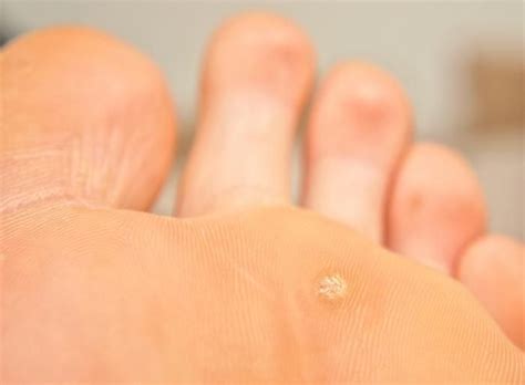 шипица на ступне | Planter warts remedies, Warts remedy, Warts