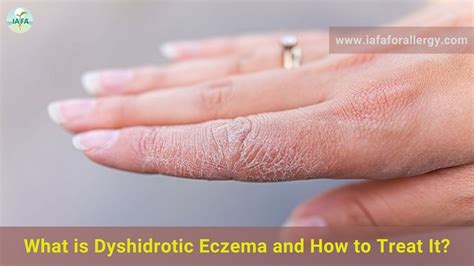 Dyshidrosis (Pompholyx) - Causes, Symptoms, Remedies, Treatment🤳 ...