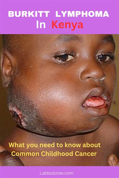 burkitt lymphoma  kenya overview  aggressive childhood cancer