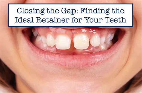 Closing the Gap: Finding the Ideal Retainer for Your Teeth – B.WEISS ...