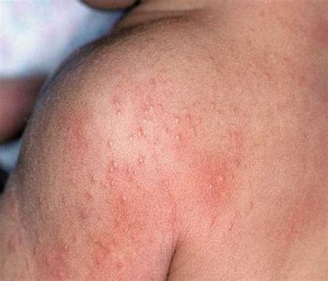 pictures of heat rash on babies - pictures, photos