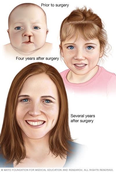 Cleft Palate Repair Before And After