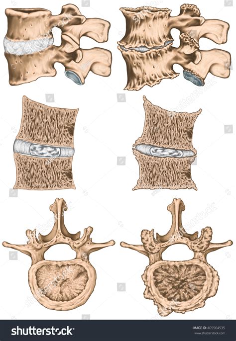 Uncovertebral: Over 34 Royalty-Free Licensable Stock Illustrations ...