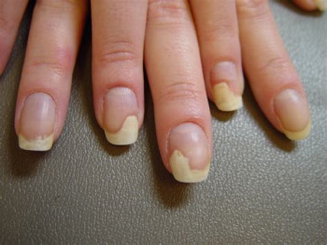 Mani Pedi Studio: Onycholiza... Czym jest i jak ją leczyć?