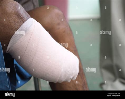 Leg Amputation Stump High Resolution Stock Photography and Images - Alamy