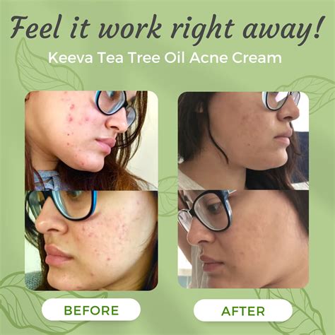 Tea Tree Oil Acne Before And After