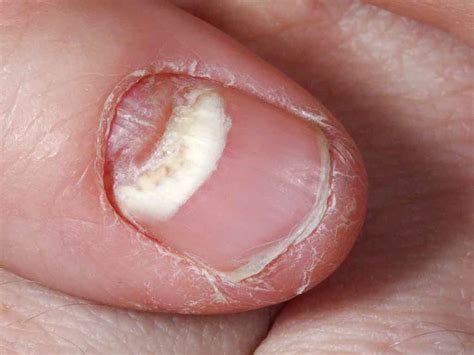 Ingrown Toenail (Onychocryptosis): Symptoms & Treatment