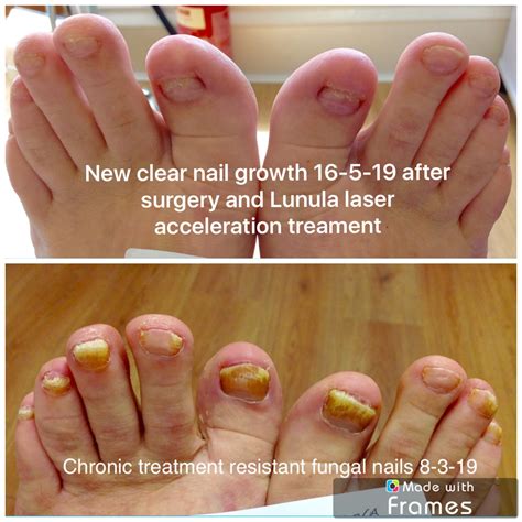 Hampshire Fungal Nail Treatments - Compleet Feet