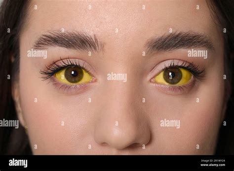 Woman with yellow eyes, closeup. Symptom of hepatitis Stock Photo - Alamy