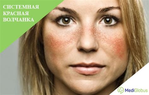 Что Такое Волчанка Фото