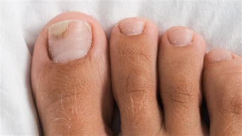 Onycholysis: Symptoms, Causes, and Treatment