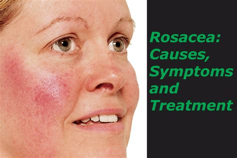 Allergies Cause Rosacea at Darcy Trugernanner blog