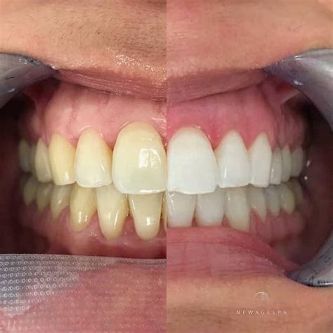 Best Teeth Whitening Experience and Fastest Results in Montreal