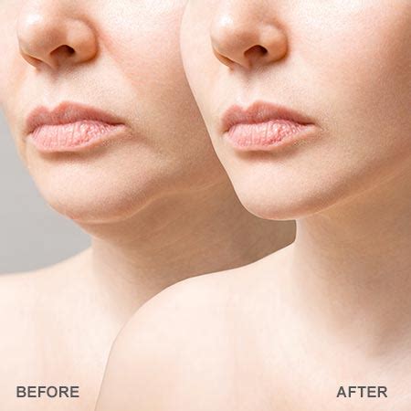 Botox For Jowls: Treatment, and Before and After