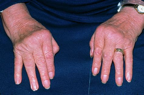 Rheumatoid Arthritis Of Hands With Ulnar Deviation Photograph by ...