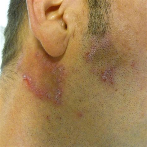 Visage « poupin » et glabre chez un sujet présentant un hypogonadisme ...