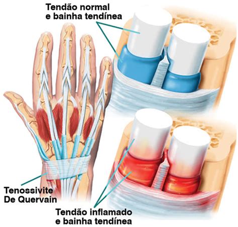 O Que É Tenossinovite