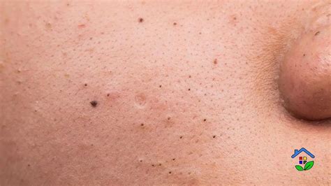 smooth  clear  natural remedies  blackheads  whiteheads removal