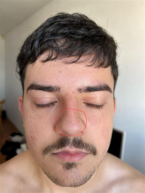 Espinha Dentro Do Nariz E Perigoso - Espinha Embaixo Do Nariz Doença Fria Para Herpes No Nariz De Um