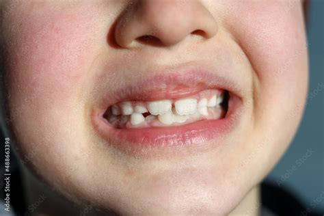 Seven year boy showing his primary and growing permanent teeth. Stock Photo | Adobe Stock