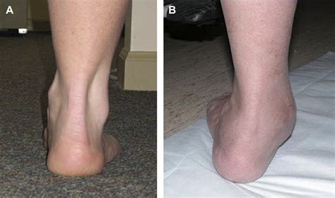 The Surgical Management of Equinus in the Adult Acquired Flatfoot