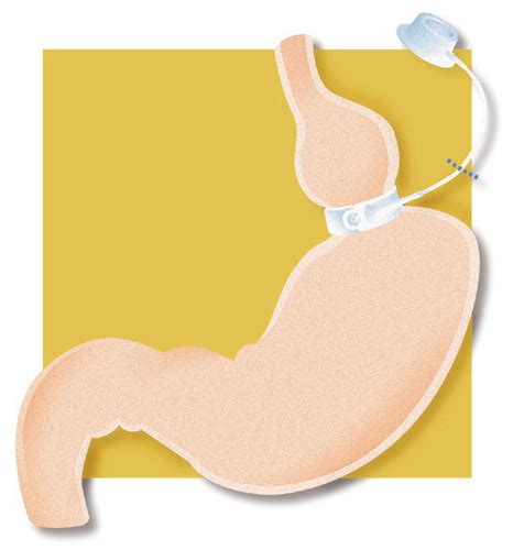 lap band procedure melbourne vic weight loss surgery melbourne vic