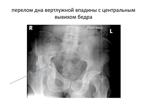 Повреждения таза и тазовых органов - презентация онлайн