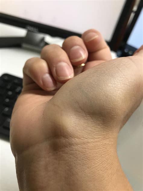 New Cyst Popping Videos 60