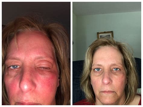 woke    eye swollen shut  poison    dr