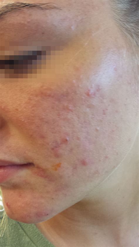 Tuberous Sclerosis, skin diseases, rush, eczema