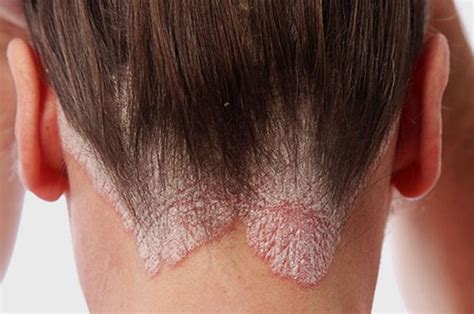 Seborrheic dermatitis: from diagnosis to treatment - Novosilska clinic