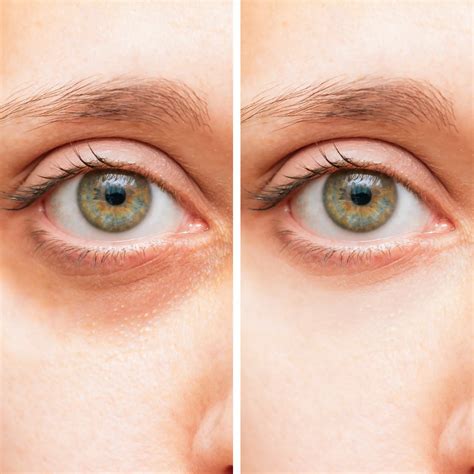 restylane eyelight injectable filler santa rosa  healdsburg