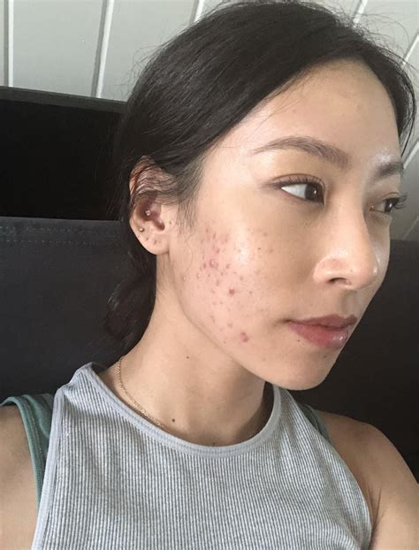 Updated Tazorac journey + advice wanted : r/tretinoin