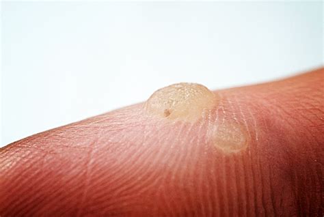Hpv Tipos De Verrugas Fotos - Infoupdate.org