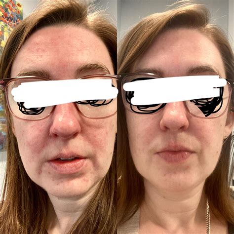 best face cream for rosacea 5