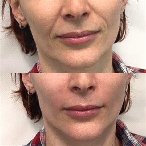 nasolabial folds treatment rejuvenate clinics