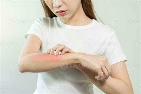 Dermatology asian young woman, girl allergy, allergic reaction from