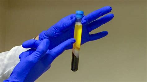 prp     work plastic surgery