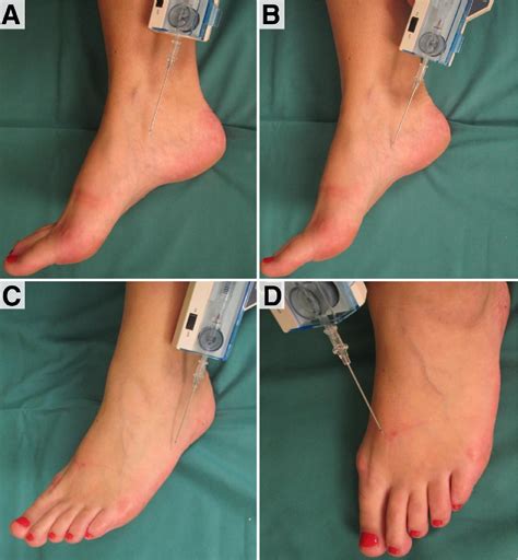 Lateral Compartment Syndrome Symptoms at Mickey Munos blog