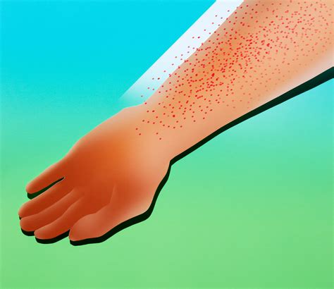 What Does A Viral Rash Look Like On A Baby Cat - Infoupdate.org