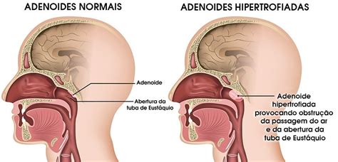 O Que É Carne Esponjosa No Nariz - Carne esponjosa no nariz: adenóides.
