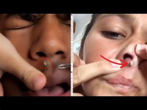 Unbelievable Blackhead Removal 2024: The Ultimate Guide to Poreless Skin - gzzbd3t