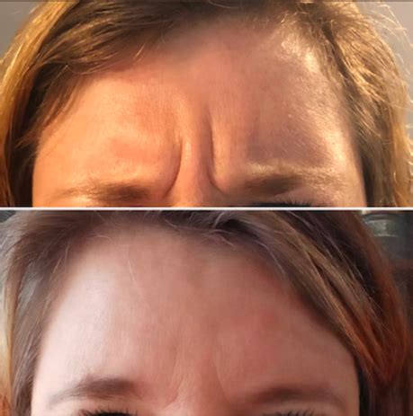 Botox fronsrimpel bij De Botoxspecialist