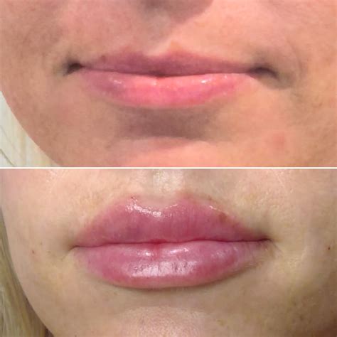 dermal fillers  grand rapids mi proper eu