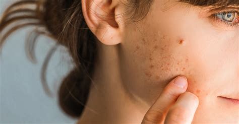 Alergia No Rosto O Que Passar - Alergia na pele: dermatologista explica como surge e tratamentos